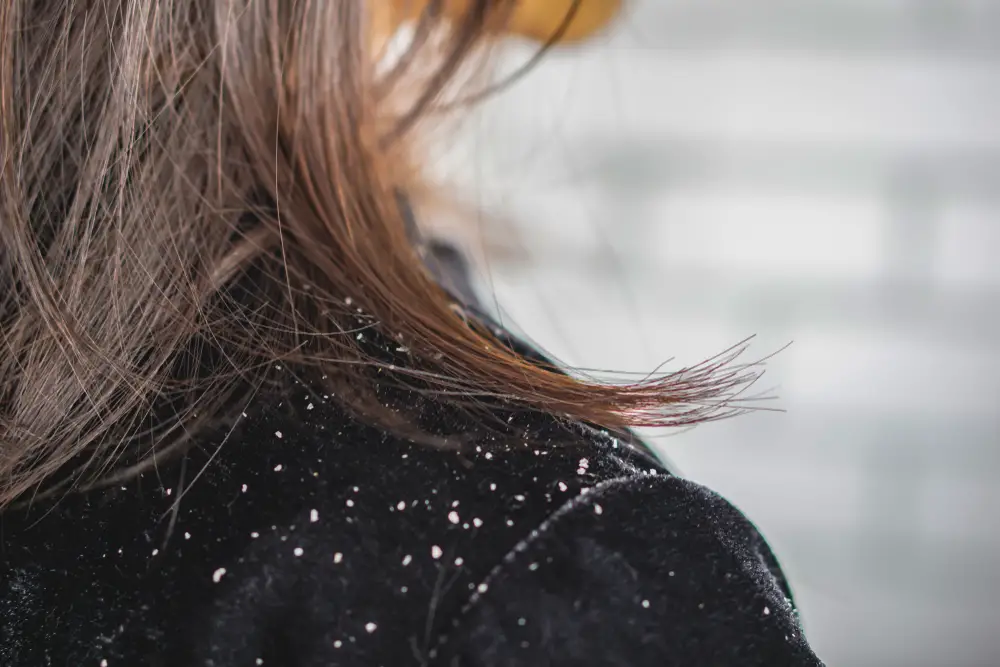 how to get rid of dandruff permanently