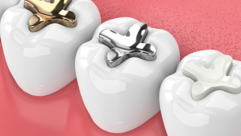How Long Does a Fill Take: Complete Guide to Dental Filling Duration